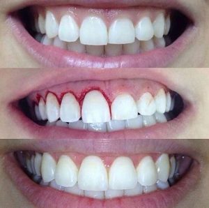 Odonto Brackets